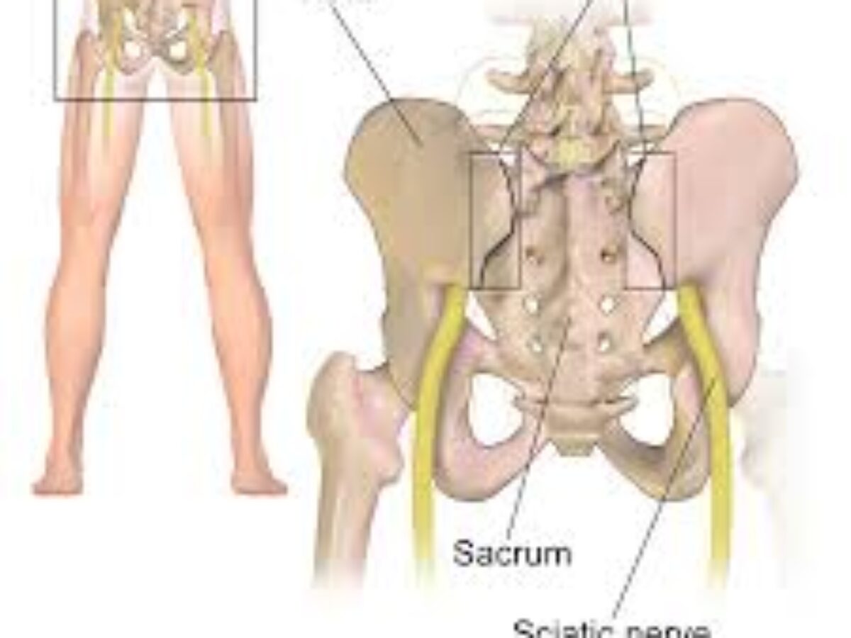 https://bristolchiropracticclinic.com/wp-content/uploads/2014/12/sciatica-1200x900.jpeg